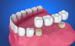 Everything You Need to Know About Dental Bridge